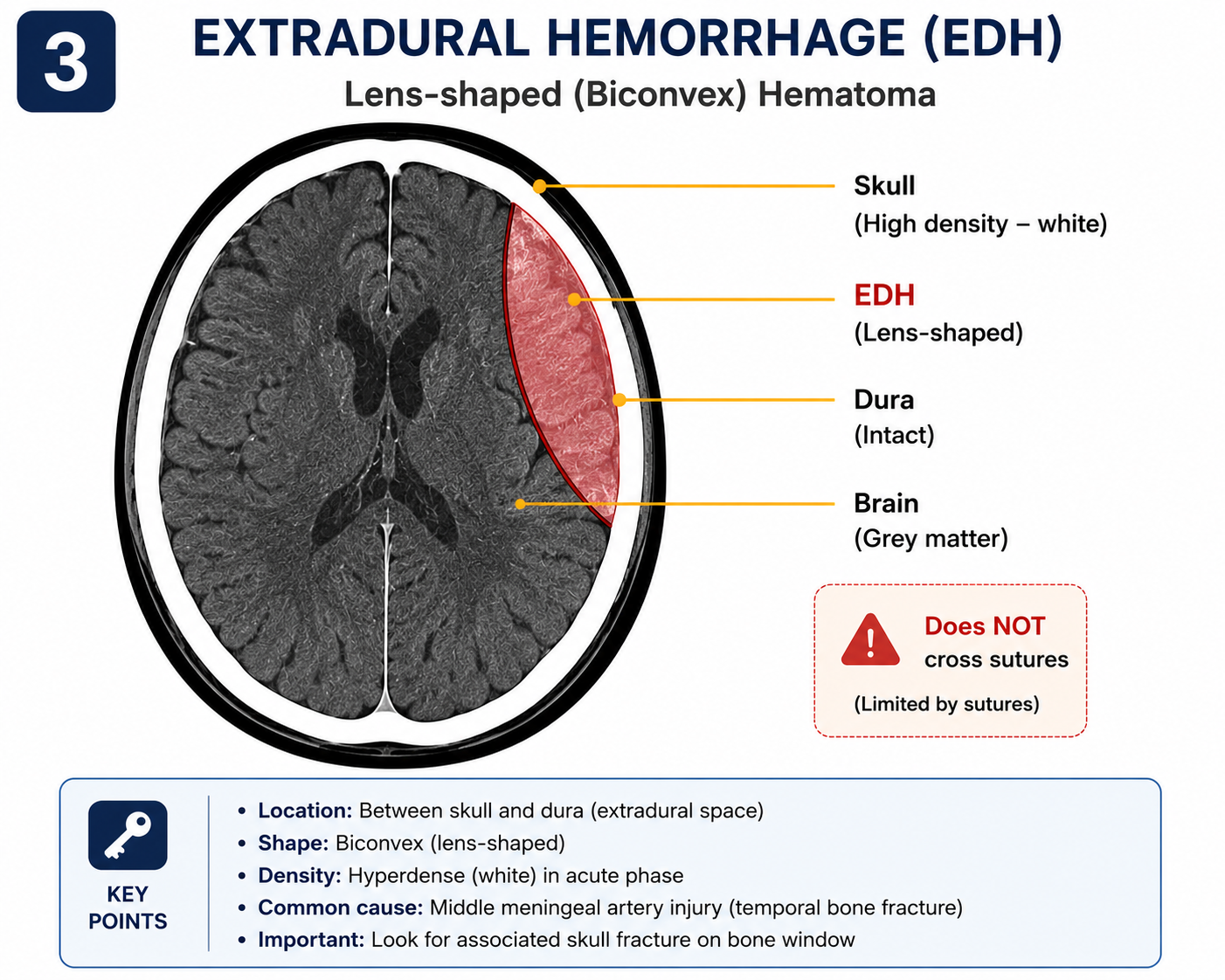 Epidural haematoma on CT - biconvex hyperdense collection