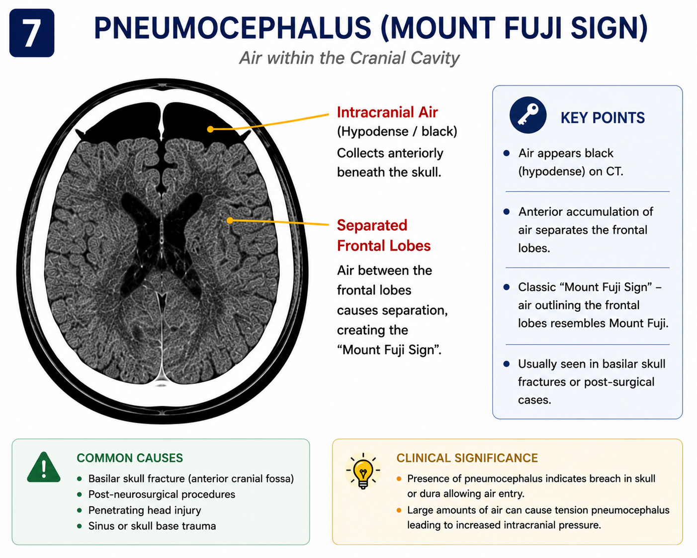 Pneumocephalus on CT - intracranial air