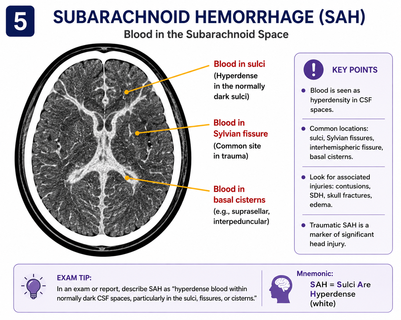 Traumatic subarachnoid haemorrhage on CT