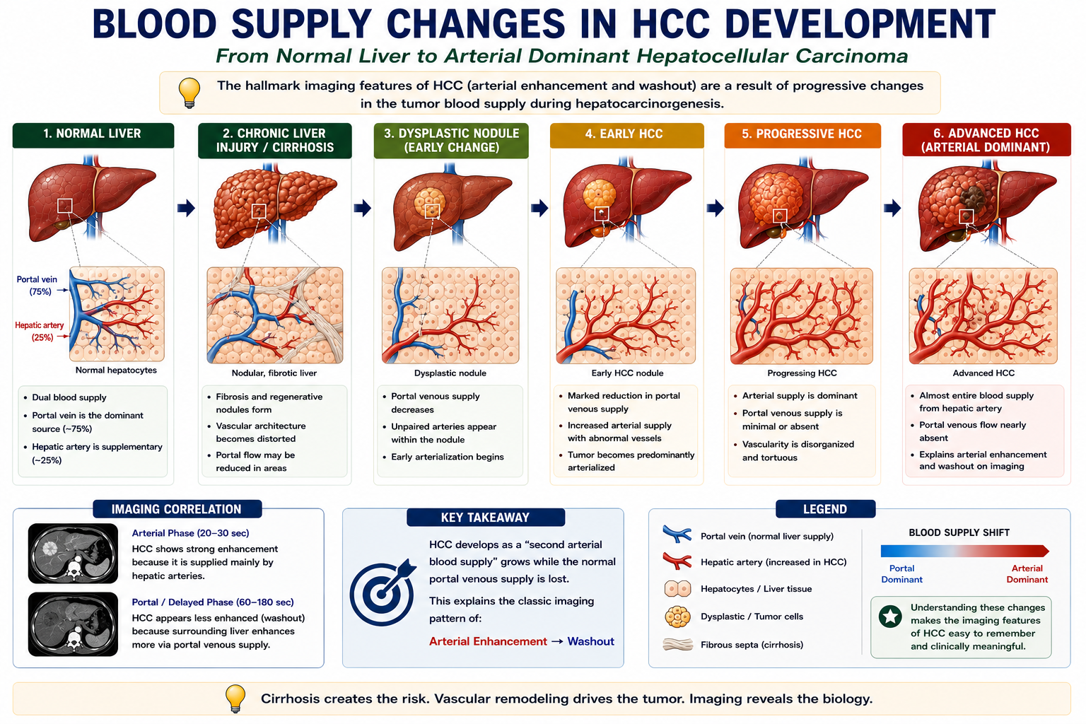 Blood supply changes in hepatocellular carcinoma showing normal portal venous liver dysplastic nodule reduced portal supply new arterial vessels and arterial dominant HCC