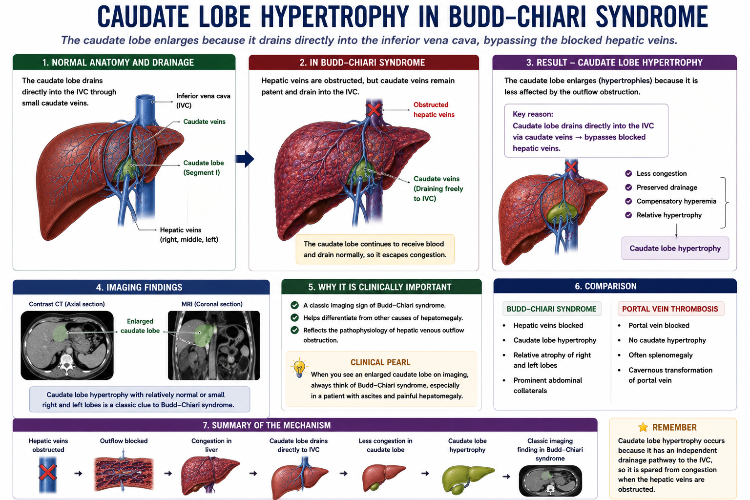 Caudate lobe hypertrophy in Budd-Chiari syndrome due to direct drainage into the inferior vena cava