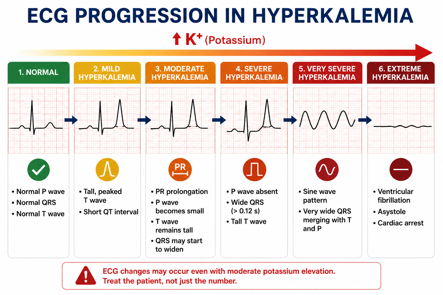 ECG changes associated with severe hyperkalemia including peaked T waves, QRS widening and sine-wave morphology