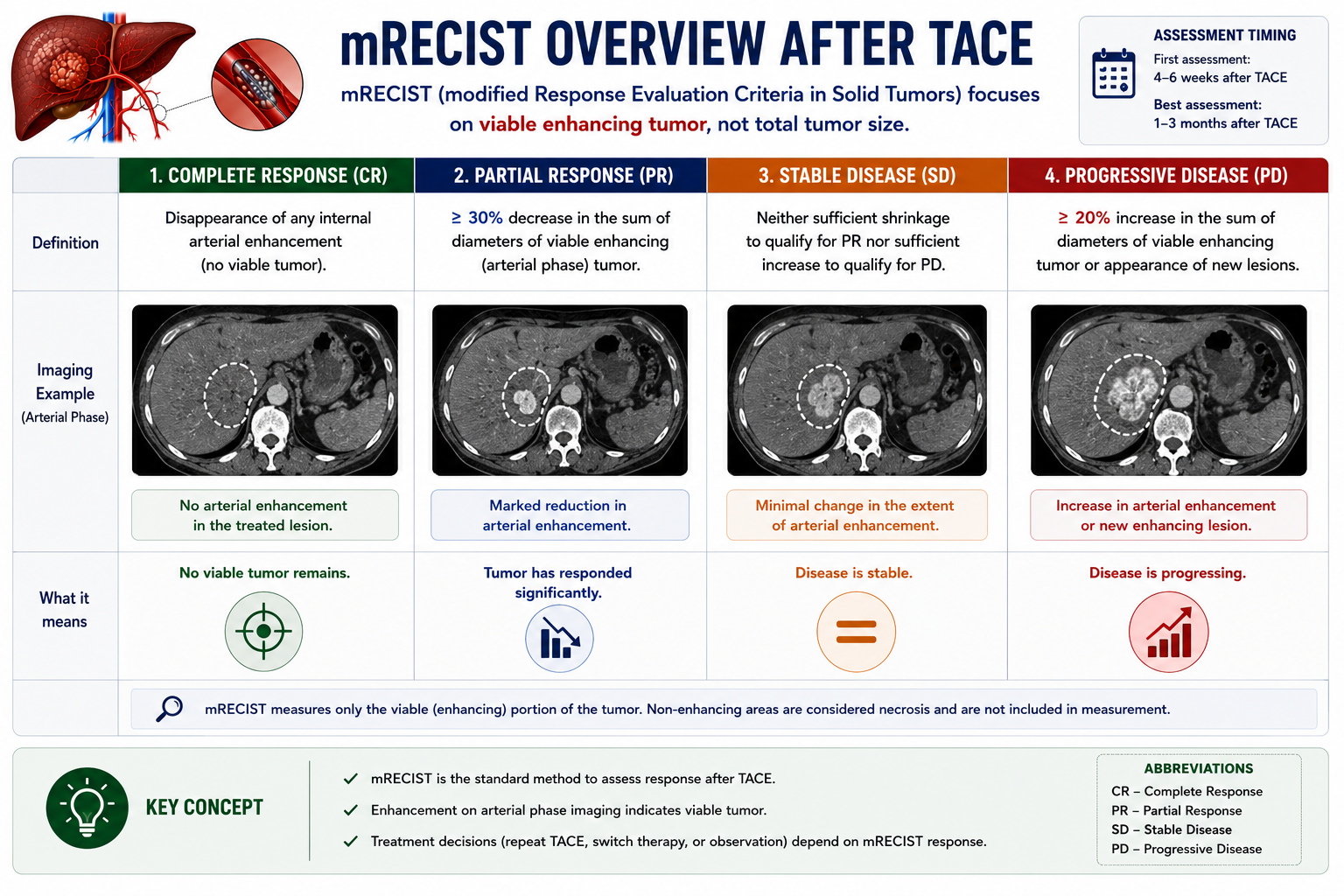 mRECIST overview after TACE showing complete response partial response stable disease and progressive disease based on viable enhancing tumor