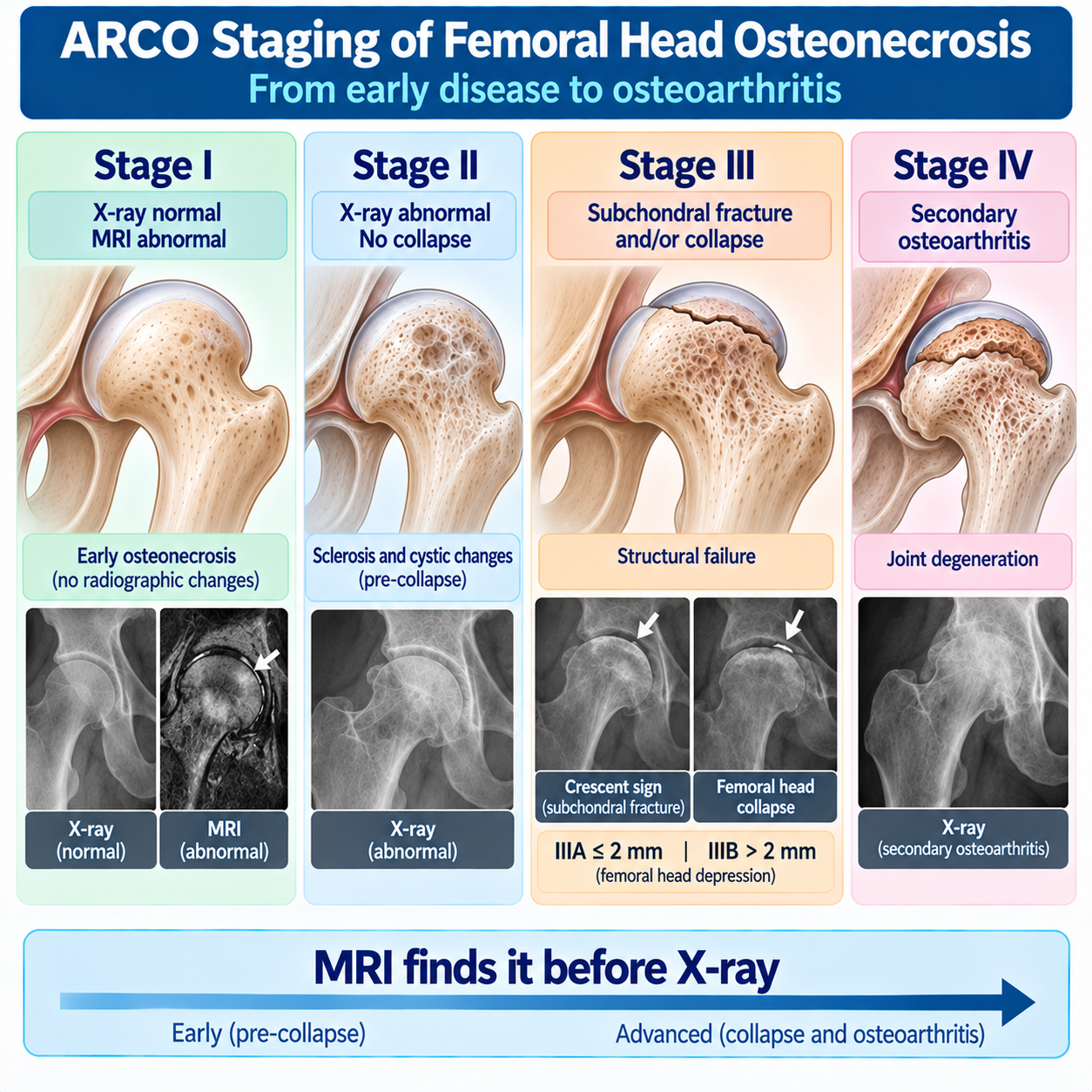 2019 ARCO staging of femoral head osteonecrosis from MRI-only stage I through pre-collapse stage II, subchondral fracture stage III and secondary osteoarthritis stage IV.