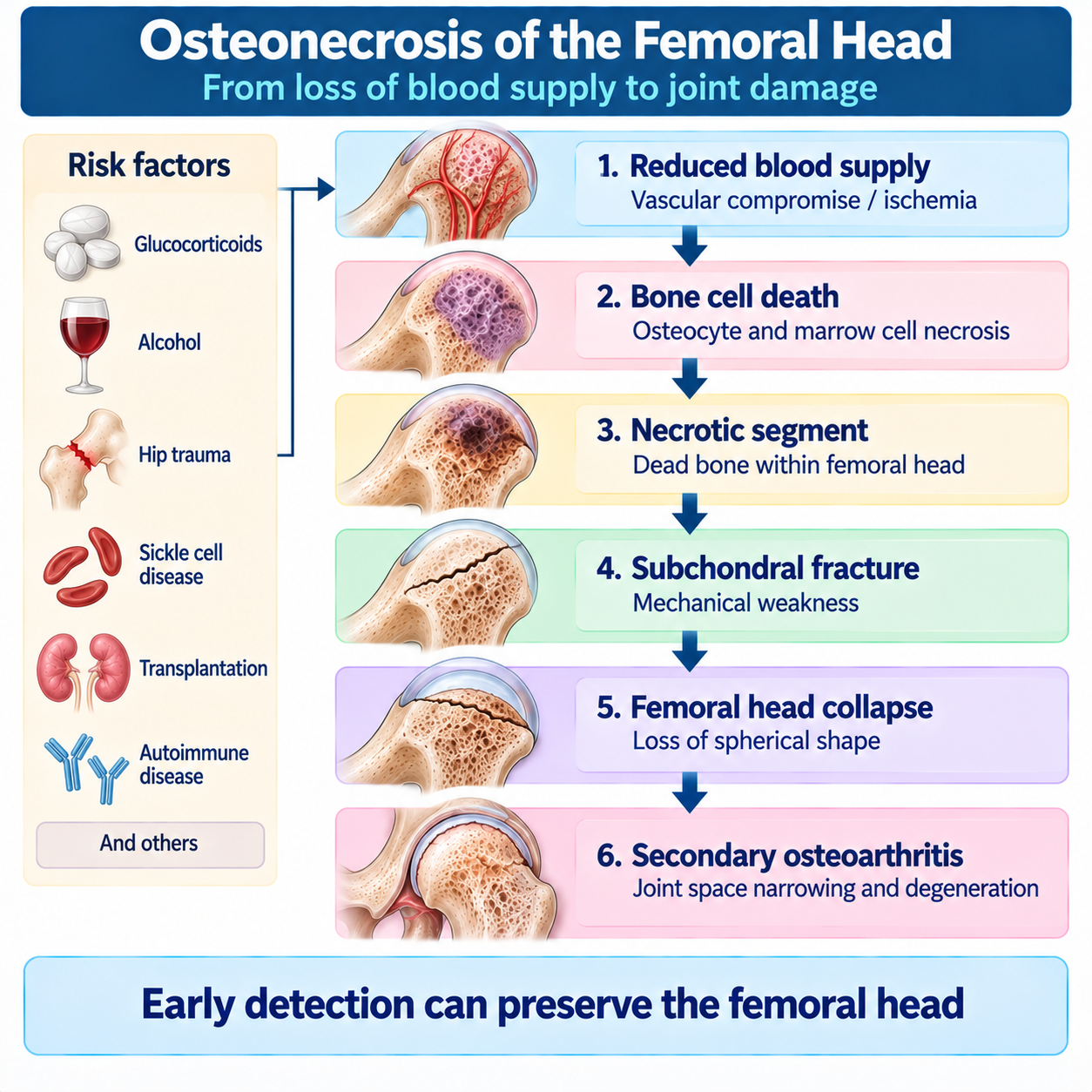 Pathway of femoral head osteonecrosis from impaired blood supply and ischemia to bone necrosis, subchondral fracture, collapse and secondary osteoarthritis.