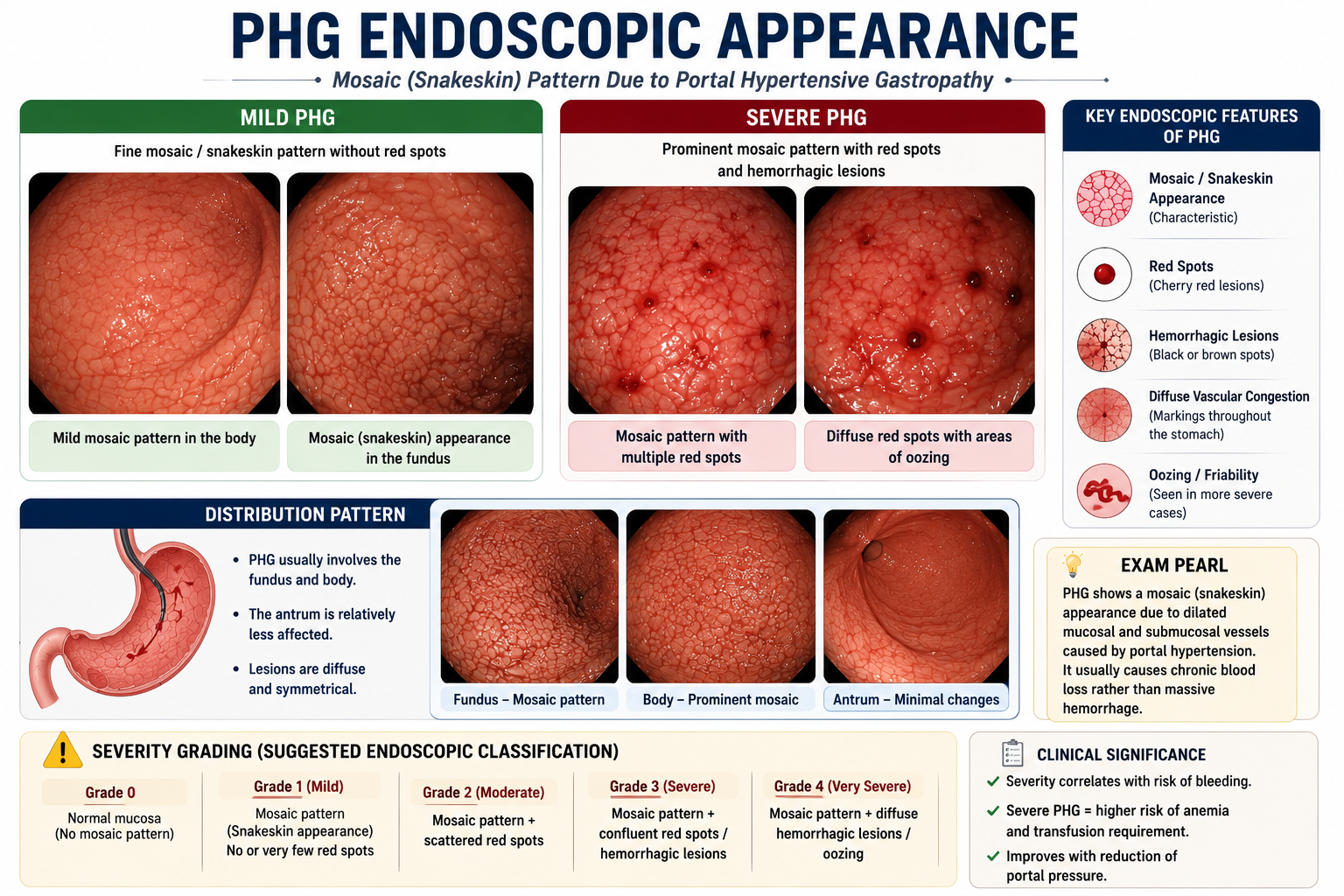Endoscopic appearance diagram of portal hypertensive gastropathy showing mild PHG with mosaic snakeskin pattern and severe PHG with additional red spots cherry-red lesions and diffuse haemorrhagic changes