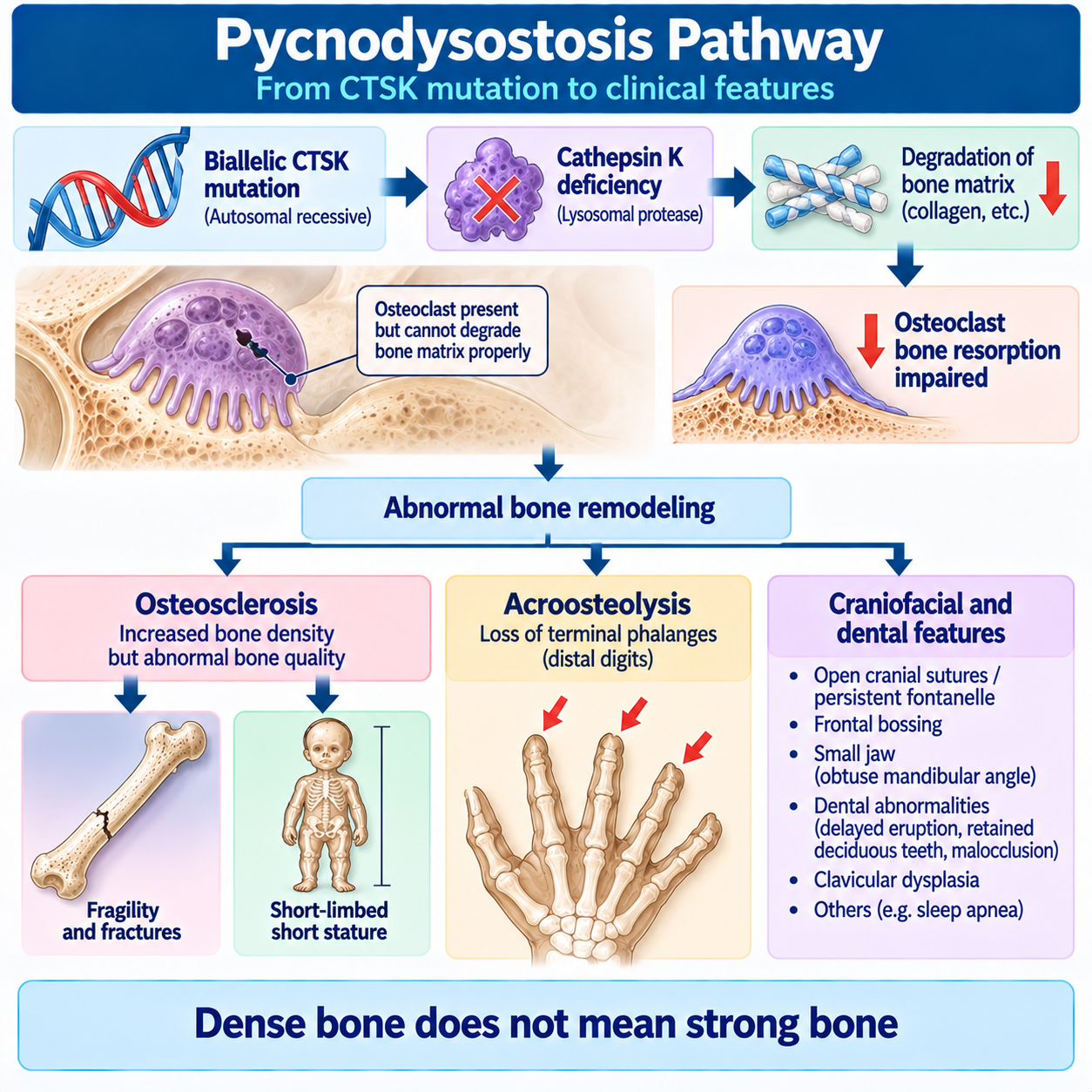 Pycnodysostosis pathway from biallelic CTSK variants and cathepsin K deficiency to impaired bone matrix degradation, osteosclerosis, fragility and acroosteolysis.