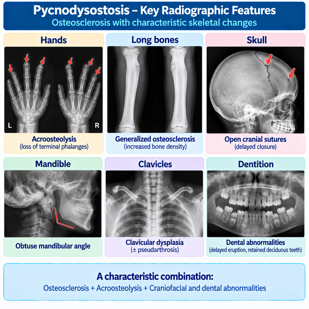 Radiographic features of pycnodysostosis showing terminal phalangeal acroosteolysis, generalized osteosclerosis, delayed cranial suture closure and obtuse mandibular angle.
