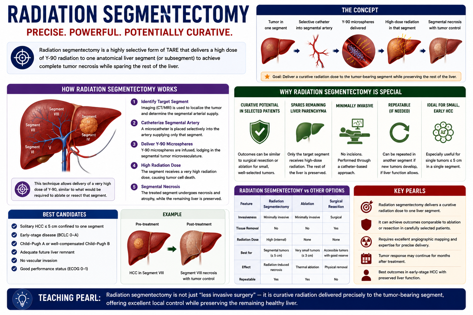 Radiation segmentectomy showing small HCC selective segmental artery high-dose Y90 segment destruction and potential curative treatment