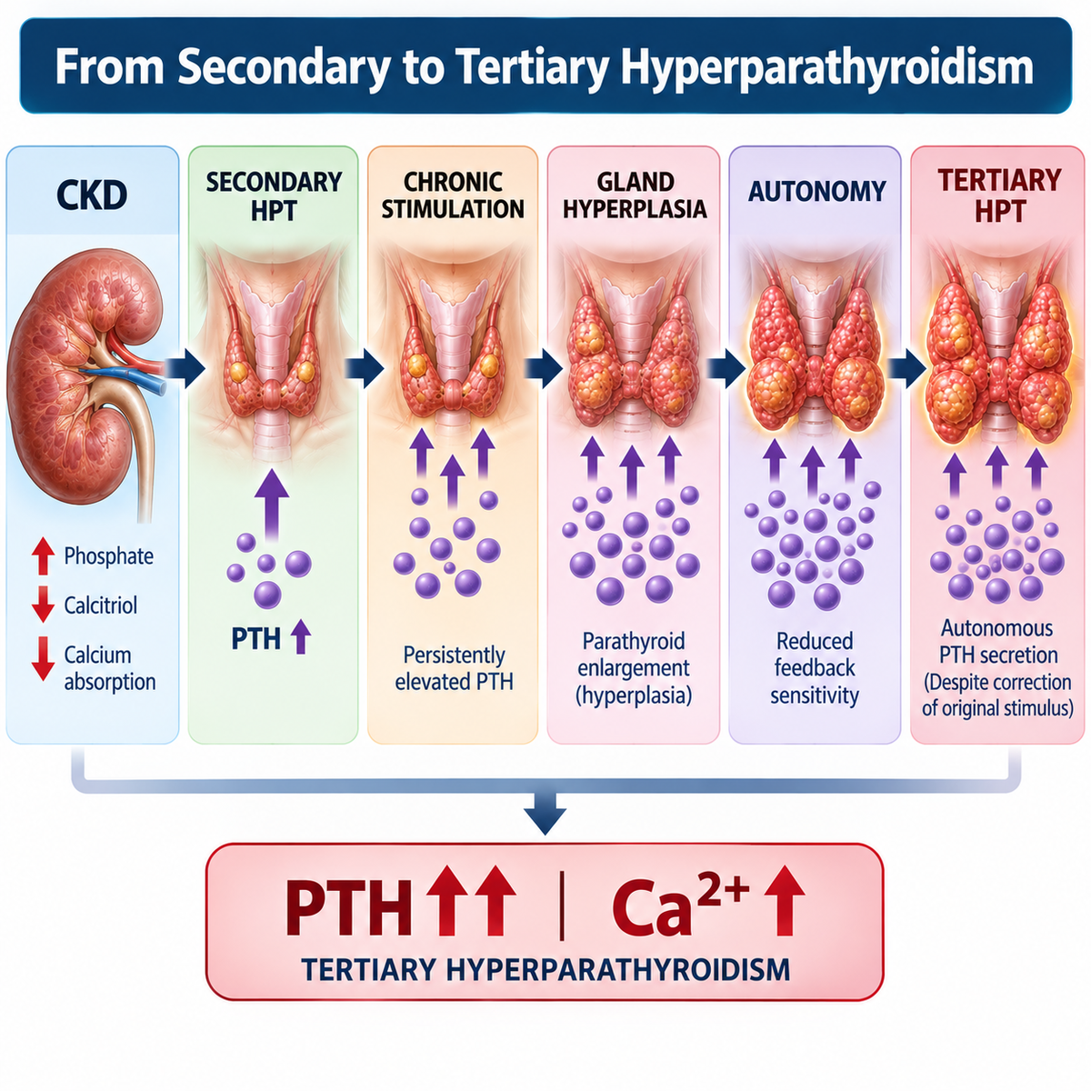 Progression from CKD secondary hyperparathyroidism through parathyroid hyperplasia to autonomous tertiary hyperparathyroidism.