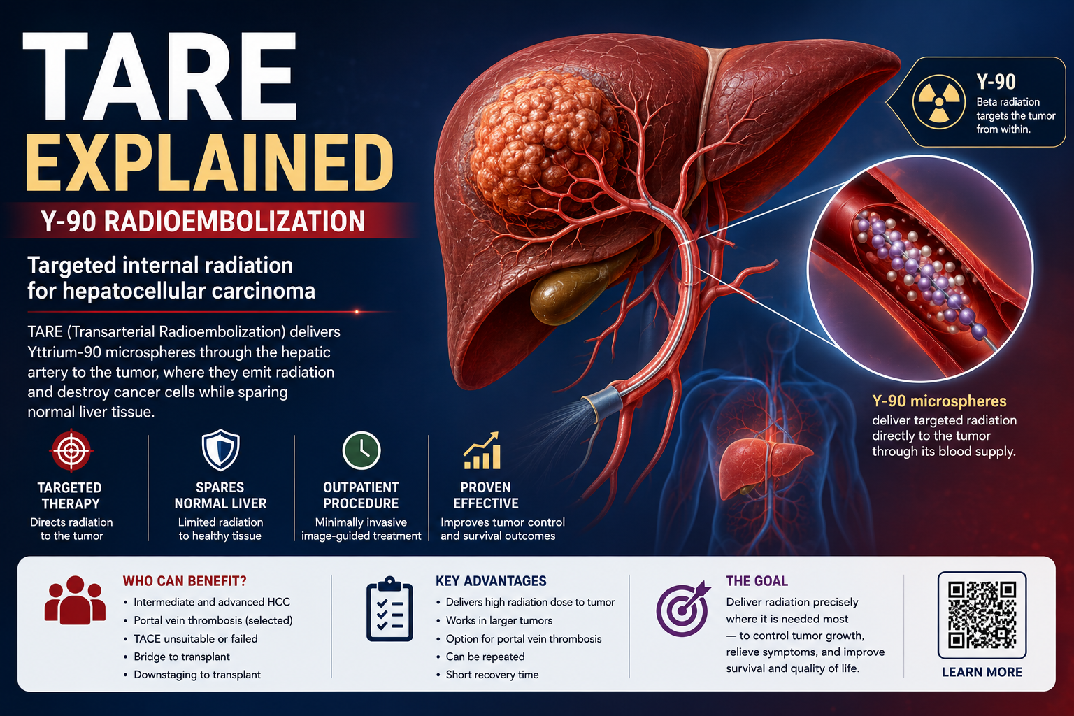 TARE Explained: Y-90 Radioembolization for Hepatocellular Carcinoma (HCC)